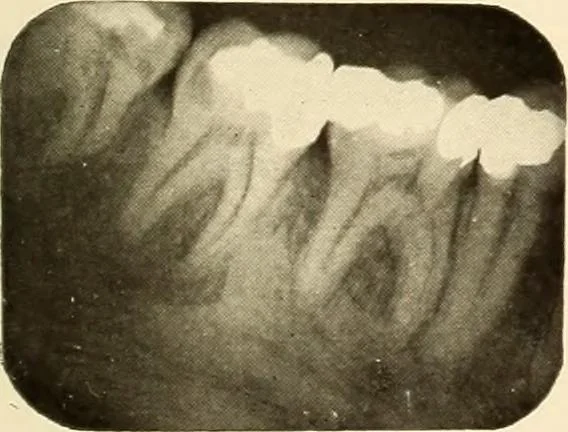An illustration from Oral Roentgenology : a Roentgen study of the anatomy and pathology of the oral cavity, 1917, leaf 100
