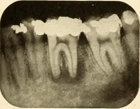 An illustration from Oral Roentgenology : a Roentgen study of the anatomy and pathology of the oral cavity, 1917, leaf 100
