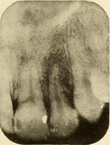 An illustration from Oral Roentgenology : a Roentgen study of the anatomy and pathology of the oral cavity, 1917, leaf 102