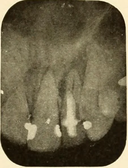 An illustration from Oral Roentgenology : a Roentgen study of the anatomy and pathology of the oral cavity, 1917, leaf 104