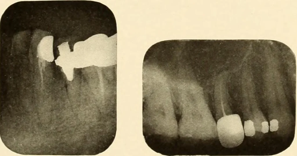 An illustration from Oral Roentgenology : a Roentgen study of the anatomy and pathology of the oral cavity, 1917, leaf 104