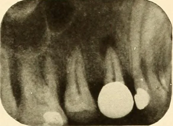 An illustration from Oral Roentgenology : a Roentgen study of the anatomy and pathology of the oral cavity, 1917, leaf 106