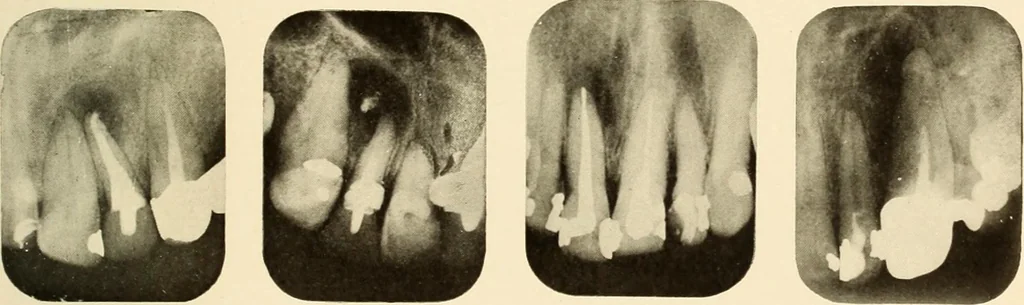An illustration from Oral Roentgenology : a Roentgen study of the anatomy and pathology of the oral cavity, 1917, leaf 106