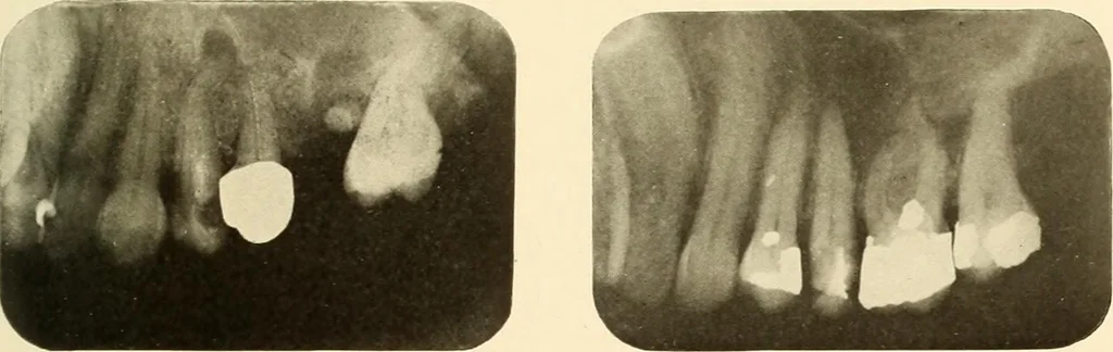 An illustration from Oral Roentgenology : a Roentgen study of the anatomy and pathology of the oral cavity, 1917, leaf 108