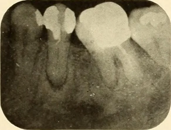 An illustration from Oral Roentgenology : a Roentgen study of the anatomy and pathology of the oral cavity, 1917, leaf 108