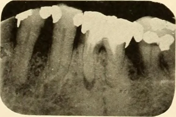 An illustration from Oral Roentgenology : a Roentgen study of the anatomy and pathology of the oral cavity, 1917, leaf 108