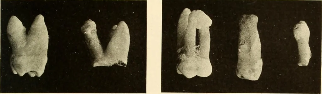 An illustration from Oral Roentgenology : a Roentgen study of the anatomy and pathology of the oral cavity, 1917, leaf 110