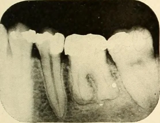 An illustration from Oral Roentgenology : a Roentgen study of the anatomy and pathology of the oral cavity, 1917, leaf 110