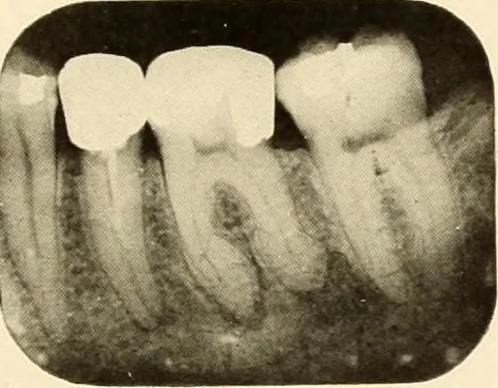 An illustration from Oral Roentgenology : a Roentgen study of the anatomy and pathology of the oral cavity, 1917, leaf 110