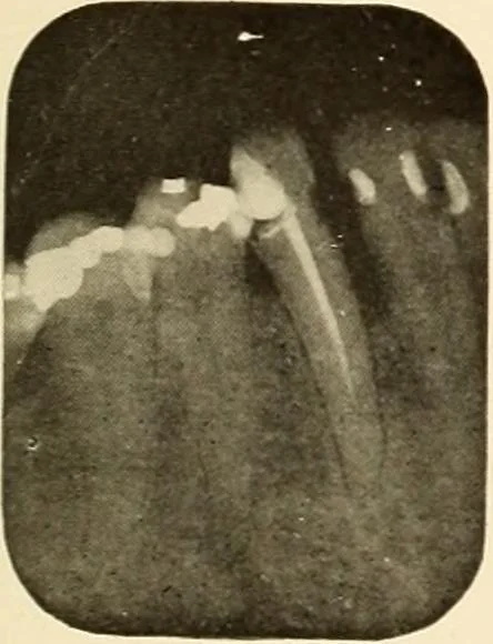 An illustration from Oral Roentgenology : a Roentgen study of the anatomy and pathology of the oral cavity, 1917, leaf 114