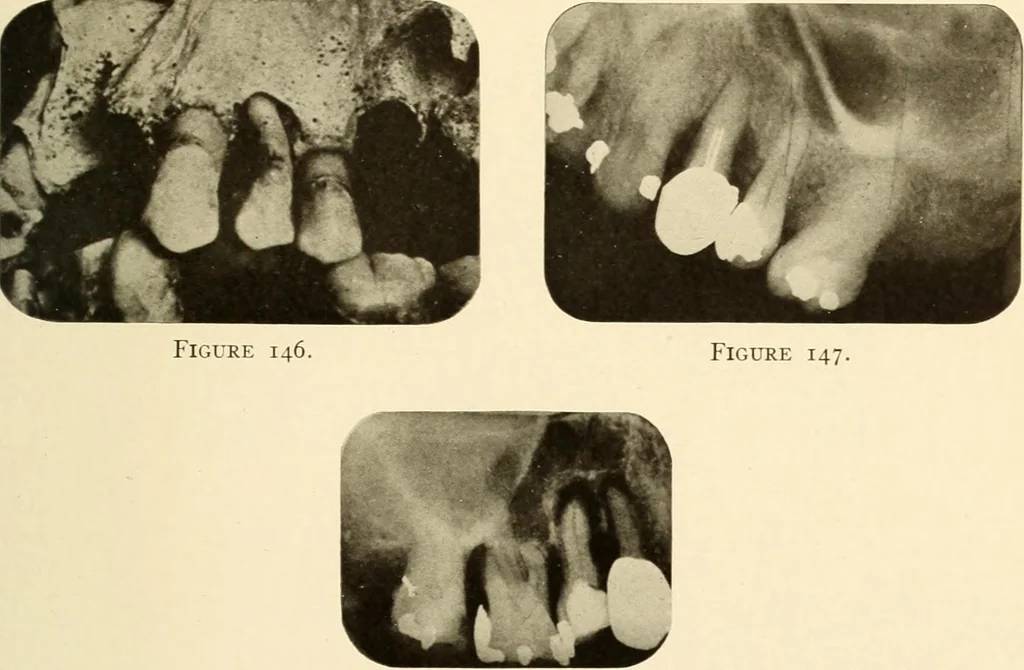 An illustration from Oral Roentgenology : a Roentgen study of the anatomy and pathology of the oral cavity, 1917, leaf 114