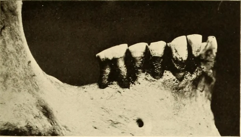 An illustration from Oral Roentgenology : a Roentgen study of the anatomy and pathology of the oral cavity, 1917, leaf 116