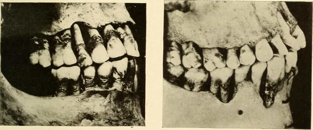 An illustration from Oral Roentgenology : a Roentgen study of the anatomy and pathology of the oral cavity, 1917, leaf 116