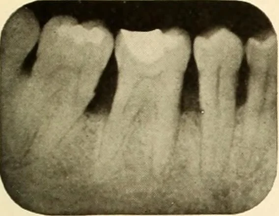 An illustration from Oral Roentgenology : a Roentgen study of the anatomy and pathology of the oral cavity, 1917, leaf 118