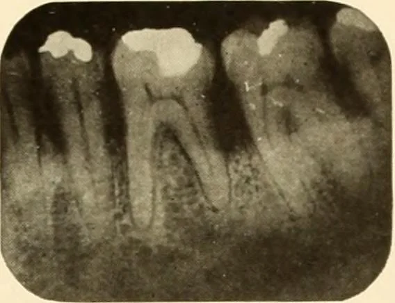 An illustration from Oral Roentgenology : a Roentgen study of the anatomy and pathology of the oral cavity, 1917, leaf 118