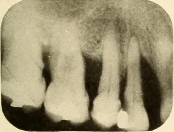 An illustration from Oral Roentgenology : a Roentgen study of the anatomy and pathology of the oral cavity, 1917, leaf 118