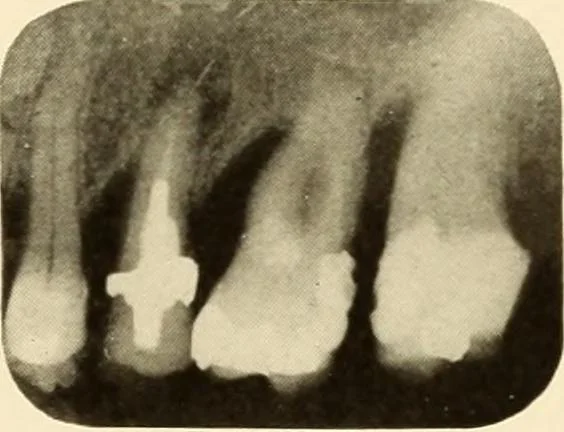 An illustration from Oral Roentgenology : a Roentgen study of the anatomy and pathology of the oral cavity, 1917, leaf 118