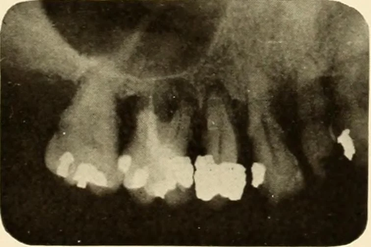 An illustration from Oral Roentgenology : a Roentgen study of the anatomy and pathology of the oral cavity, 1917, leaf 118