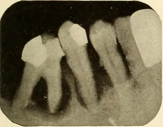 An illustration from Oral Roentgenology : a Roentgen study of the anatomy and pathology of the oral cavity, 1917, leaf 120