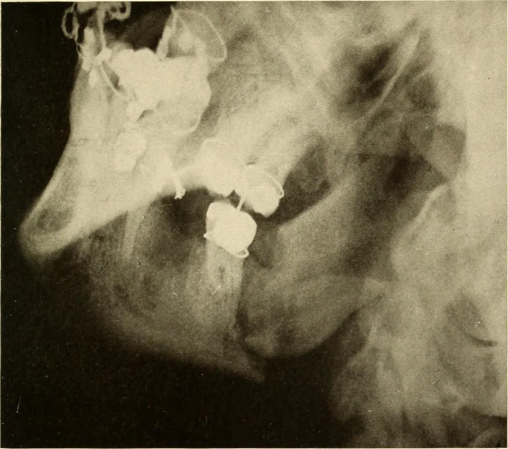 An illustration from Oral Roentgenology : a Roentgen study of the anatomy and pathology of the oral cavity, 1917, leaf 128