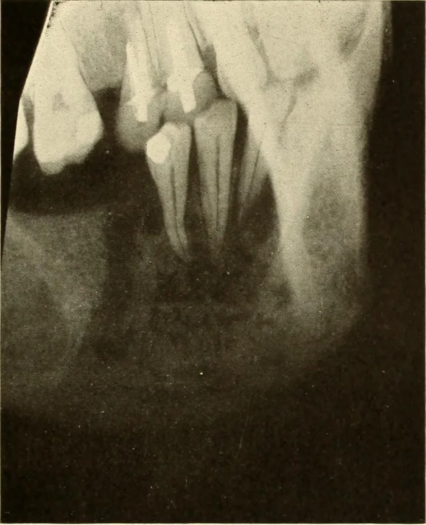 An illustration from Oral Roentgenology : a Roentgen study of the anatomy and pathology of the oral cavity, 1917, leaf 132