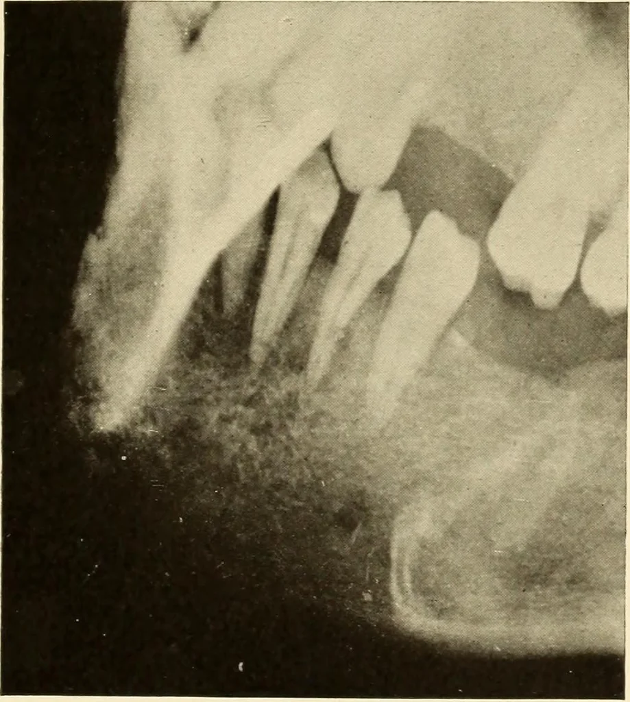 An illustration from Oral Roentgenology : a Roentgen study of the anatomy and pathology of the oral cavity, 1917, leaf 132