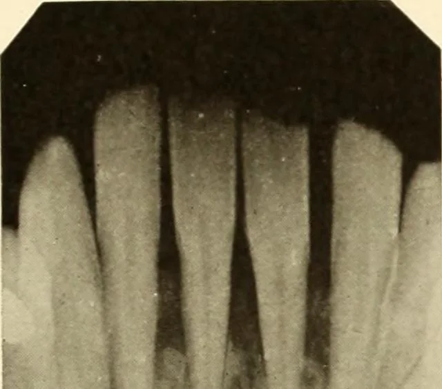An illustration from Oral Roentgenology : a Roentgen study of the anatomy and pathology of the oral cavity, 1917, leaf 134