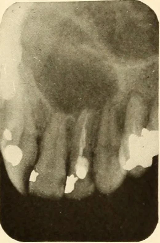 An illustration from Oral Roentgenology : a Roentgen study of the anatomy and pathology of the oral cavity, 1917, leaf 136