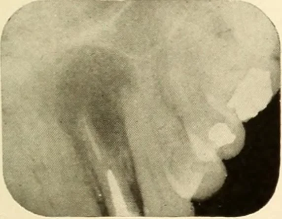 An illustration from Oral Roentgenology : a Roentgen study of the anatomy and pathology of the oral cavity, 1917, leaf 136