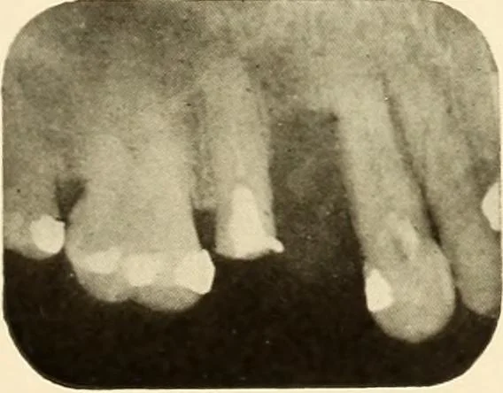 An illustration from Oral Roentgenology : a Roentgen study of the anatomy and pathology of the oral cavity, 1917, leaf 136