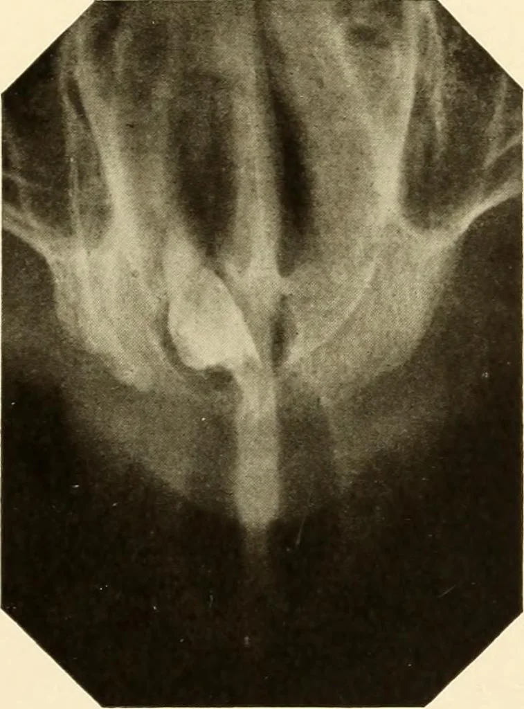 An illustration from Oral Roentgenology : a Roentgen study of the anatomy and pathology of the oral cavity, 1917, leaf 138