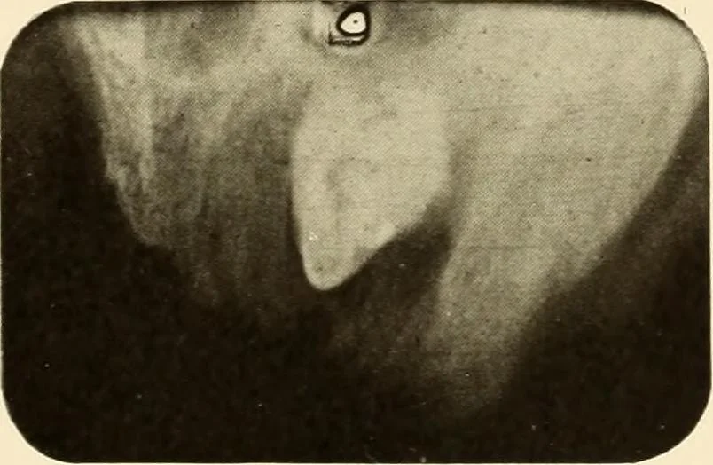 An illustration from Oral Roentgenology : a Roentgen study of the anatomy and pathology of the oral cavity, 1917, leaf 138