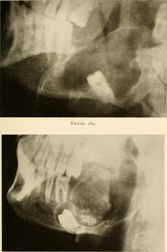 An illustration from Oral Roentgenology : a Roentgen study of the anatomy and pathology of the oral cavity, 1917, leaf 142