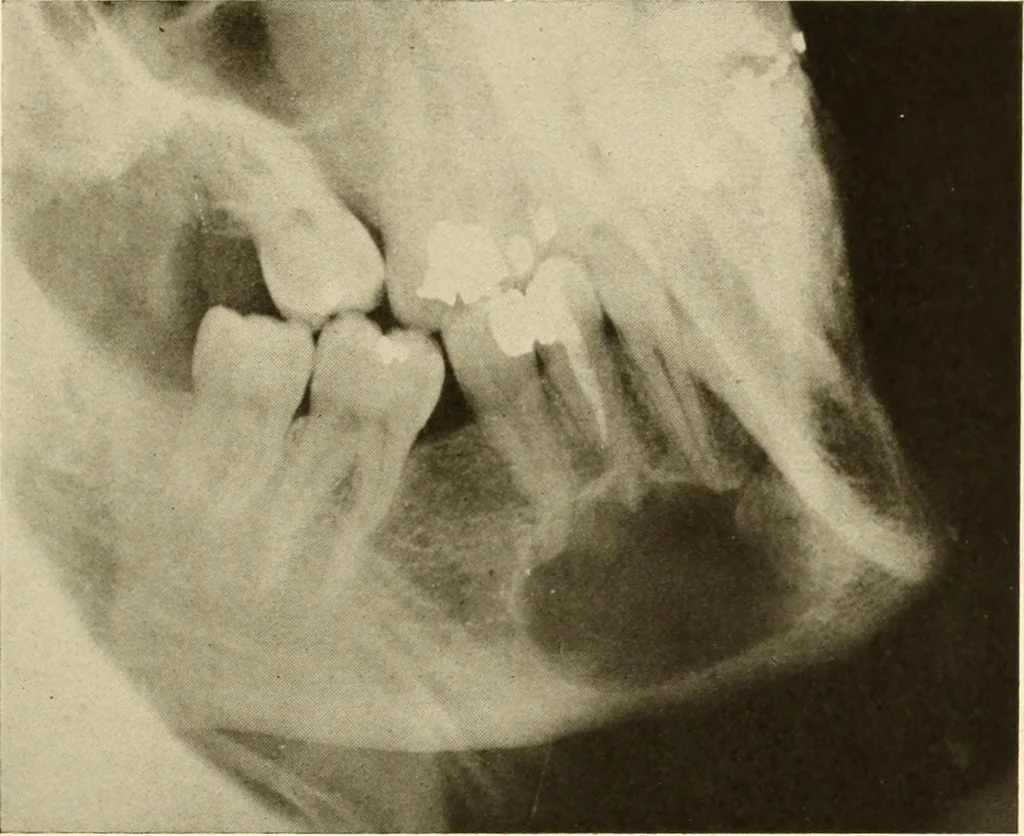An illustration from Oral Roentgenology : a Roentgen study of the anatomy and pathology of the oral cavity, 1917, leaf 144