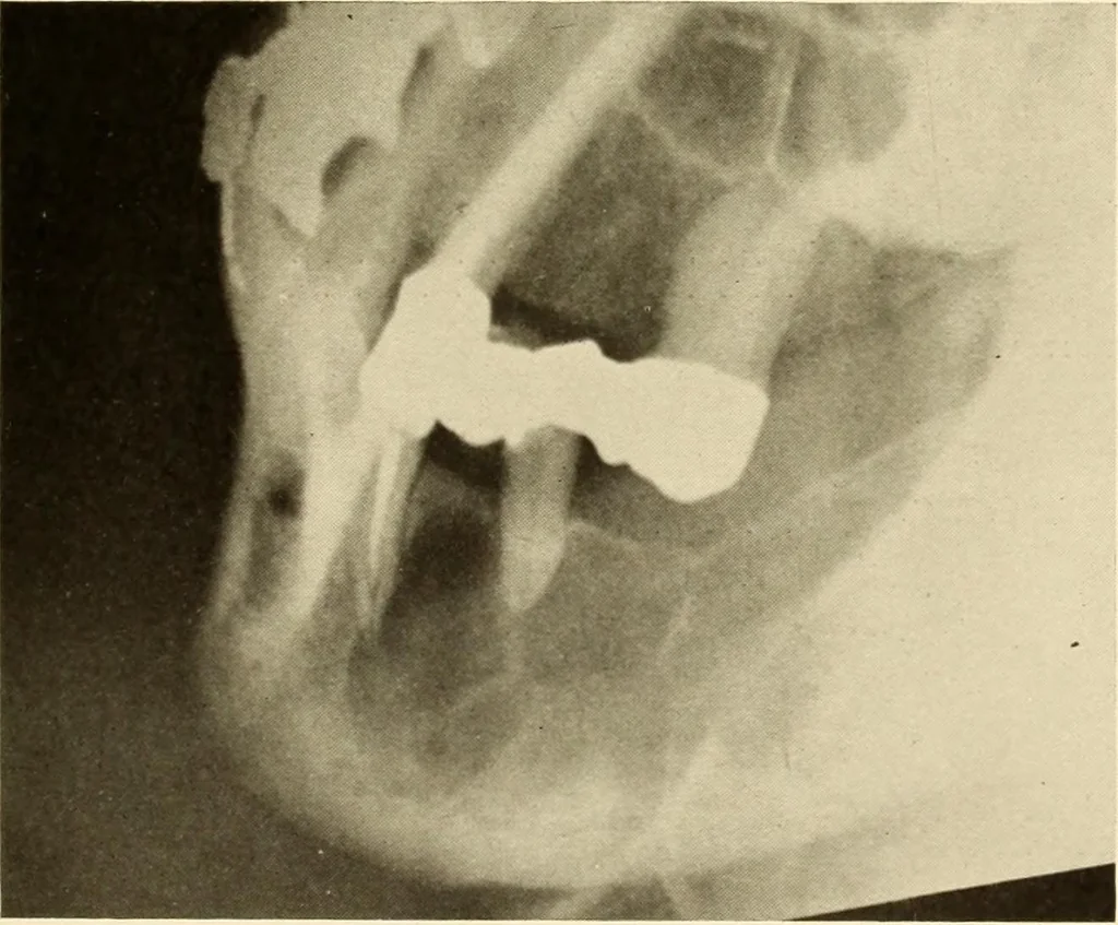 An illustration from Oral Roentgenology : a Roentgen study of the anatomy and pathology of the oral cavity, 1917, leaf 144