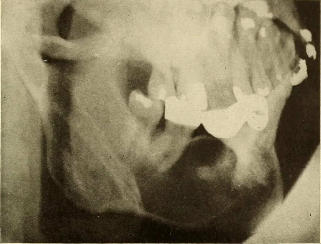 An illustration from Oral Roentgenology : a Roentgen study of the anatomy and pathology of the oral cavity, 1917, leaf 146