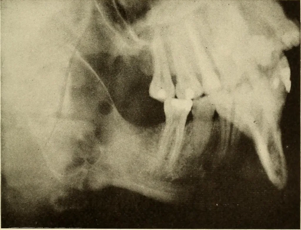 An illustration from Oral Roentgenology : a Roentgen study of the anatomy and pathology of the oral cavity, 1917, leaf 146