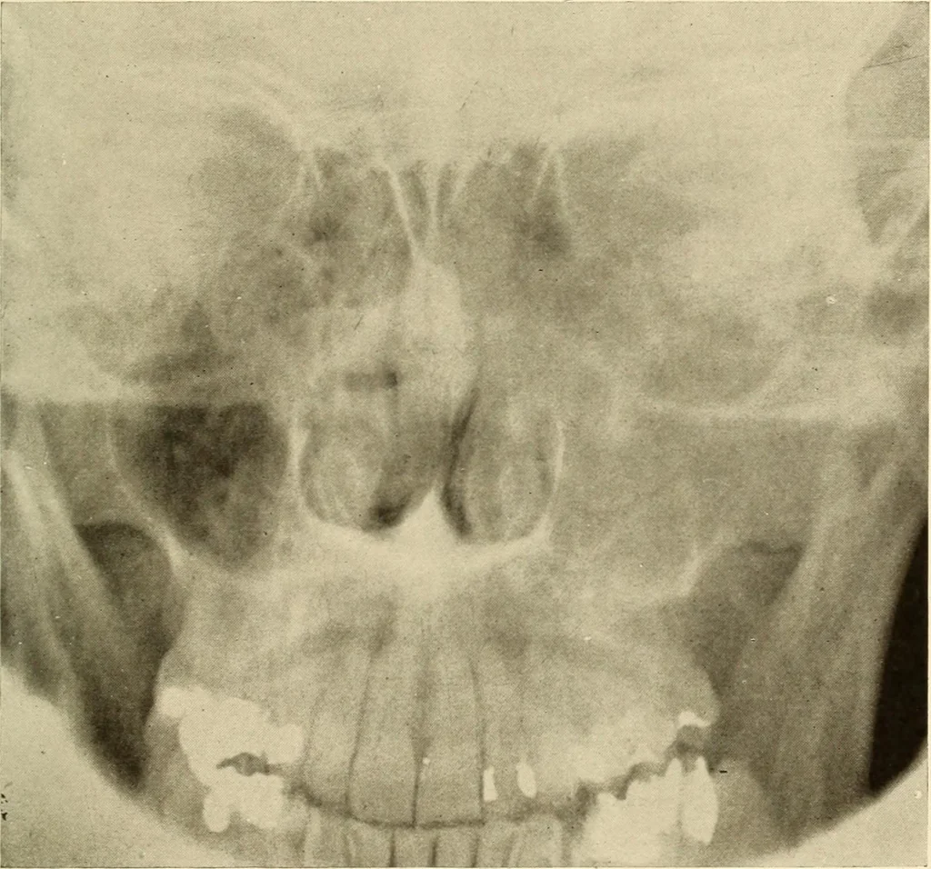An illustration from Oral Roentgenology : a Roentgen study of the anatomy and pathology of the oral cavity, 1917, leaf 156