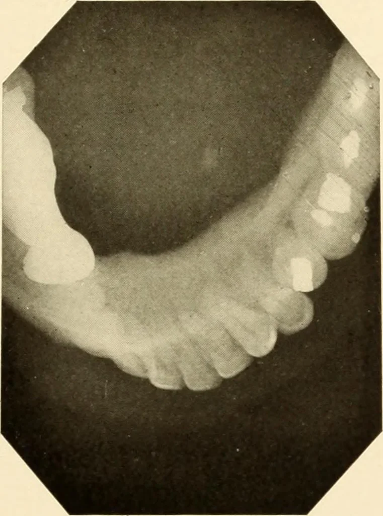 An illustration from Oral Roentgenology : a Roentgen study of the anatomy and pathology of the oral cavity, 1917, leaf 160