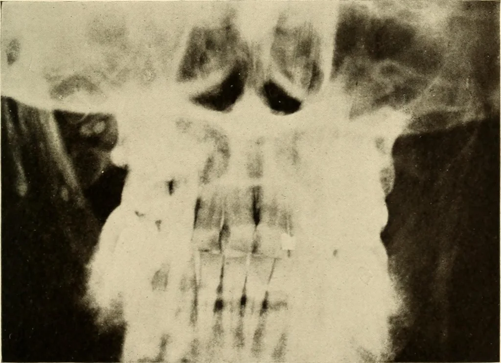 An illustration from Oral Roentgenology : a Roentgen study of the anatomy and pathology of the oral cavity, 1917, leaf 162