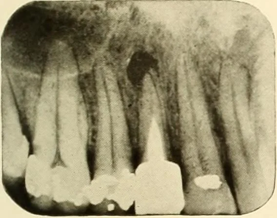 An illustration from Oral Roentgenology : a Roentgen study of the anatomy and pathology of the oral cavity, 1917, leaf 170