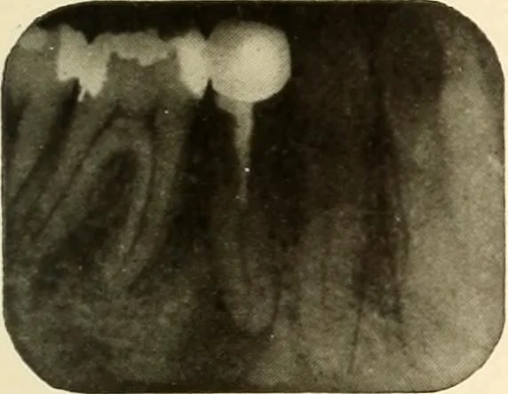 An illustration from Oral Roentgenology : a Roentgen study of the anatomy and pathology of the oral cavity, 1917, leaf 170