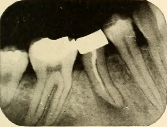 An illustration from Oral Roentgenology : a Roentgen study of the anatomy and pathology of the oral cavity, 1917, leaf 170
