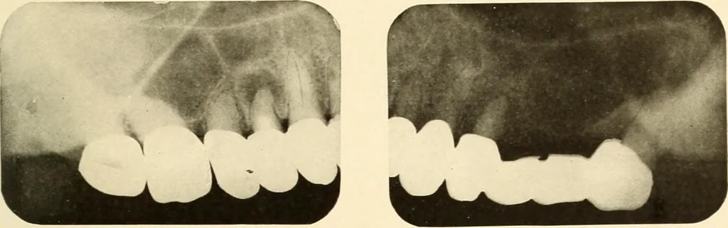 An illustration from Oral Roentgenology : a Roentgen study of the anatomy and pathology of the oral cavity, 1917, leaf 172
