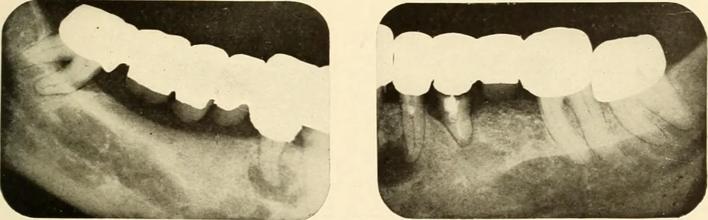 An illustration from Oral Roentgenology : a Roentgen study of the anatomy and pathology of the oral cavity, 1917, leaf 172