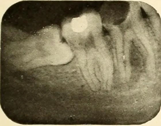 An illustration from Oral Roentgenology : a Roentgen study of the anatomy and pathology of the oral cavity, 1917, leaf 174