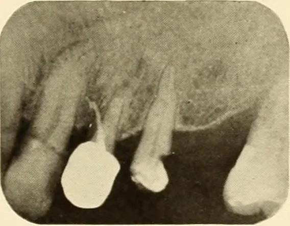 An illustration from Oral Roentgenology : a Roentgen study of the anatomy and pathology of the oral cavity, 1917, leaf 174