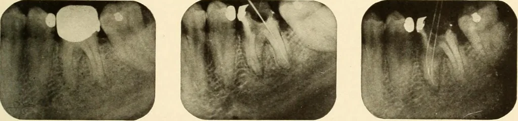 An illustration from Oral Roentgenology : a Roentgen study of the anatomy and pathology of the oral cavity, 1917, leaf 176