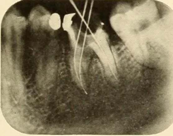 An illustration from Oral Roentgenology : a Roentgen study of the anatomy and pathology of the oral cavity, 1917, leaf 176