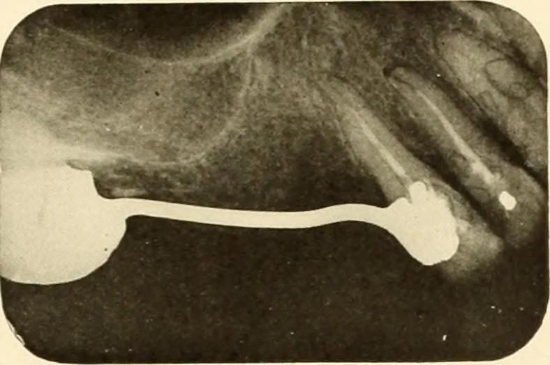 An illustration from Oral Roentgenology : a Roentgen study of the anatomy and pathology of the oral cavity, 1917, leaf 178